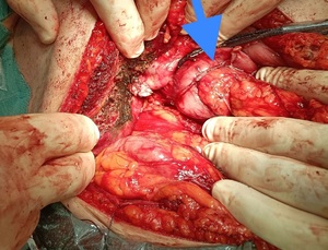 Figure from article: Upper GI bleeding as a...