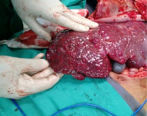 Figure from article: Giant hepatic hemangioma...