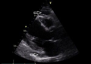 Figure from article: Cardiac tamponade due to...