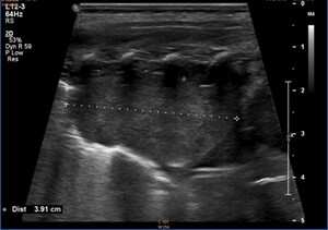 Figure from article: Neonatal neuroblastoma